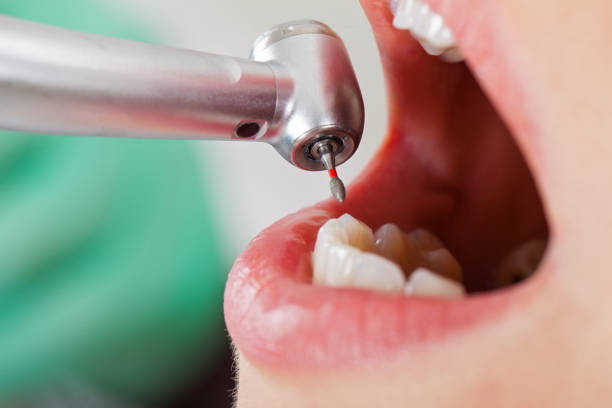 Best Emergency Wisdom Teeth Removal in Bethany, OR